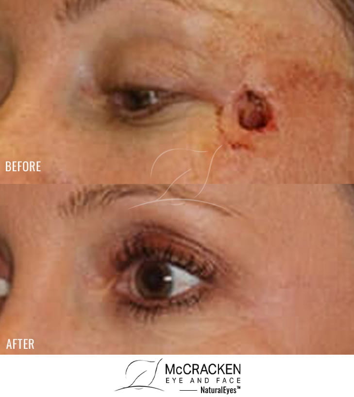 40 Year Old Female – Repair of left cheek defect after skin cancer excision.