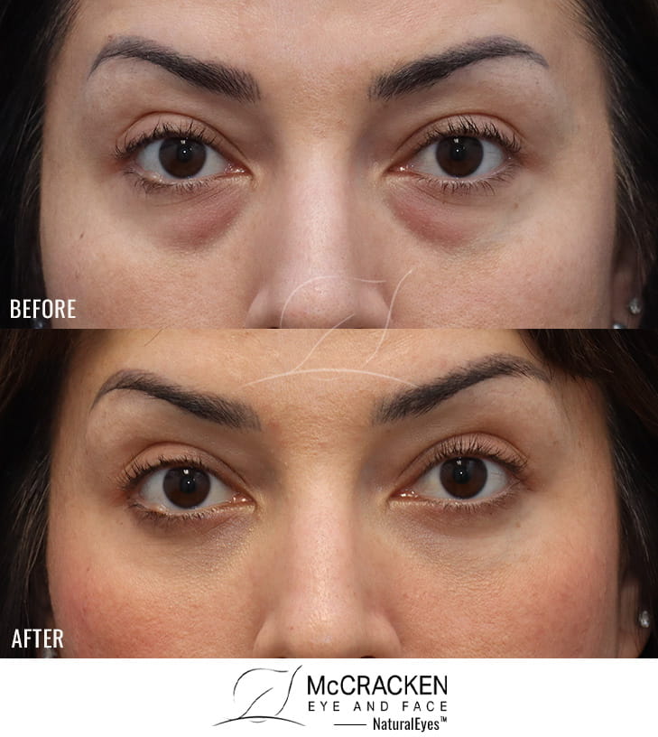 36 Year Old Female Lower Lid Blepharoplasty with Fat Repositioning, Injection of 3cc of Fat to Each Cheek, and injection of 1cc of nanofat to each lower lid. No Lower Lid Skin Incisions were made.
