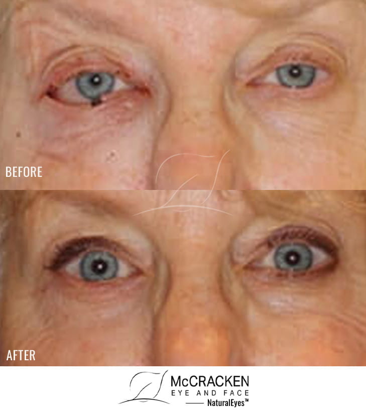 66 Year Old Female – Repair of right lower lid defect after skin cancer excision.