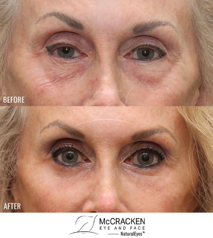 71 Year Old Female Upper Lid Ptosis Repair and Lower Lid Blepharoplasty with Fat Excision and Skin Pinch Excision, Injection of Fat to Each Cheek, and Laser Skin Resurfacing.