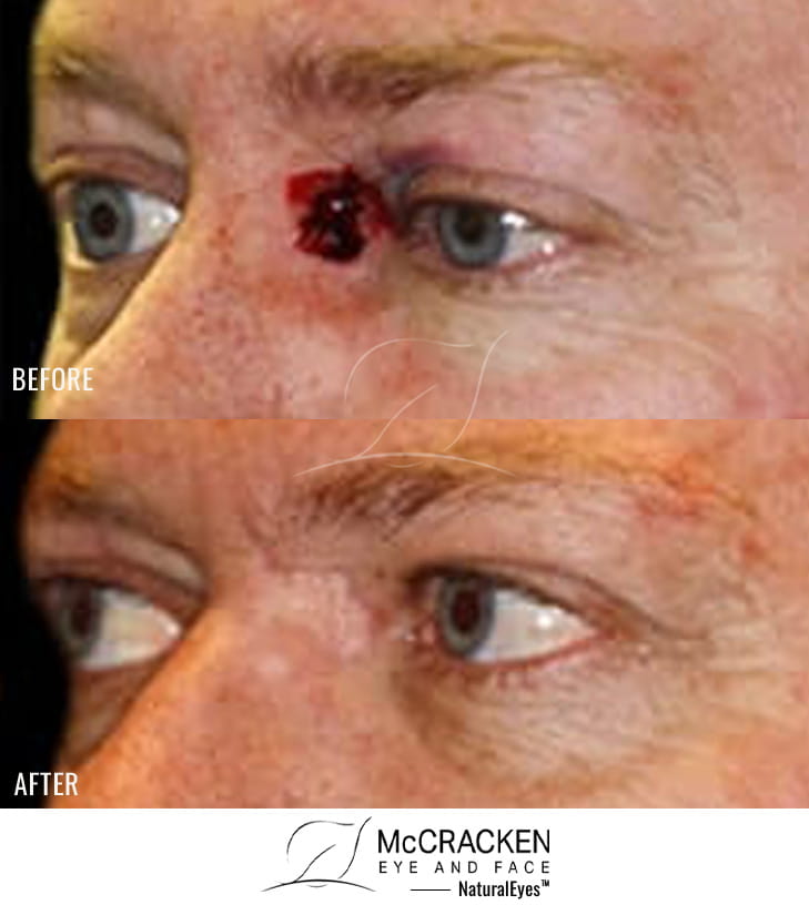 50 Year Old Male – Repair of right medial canthal defect after skin cancer excision.