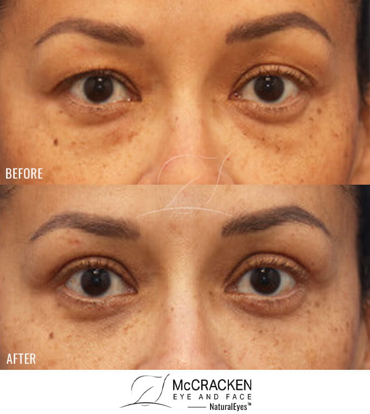 44 Year Old Female Upper and Lower Lid Blepharoplasty with Transfer of the Nasal Fat Pads into the Tear Troughs and Injection of 3cc of Fat to Each Cheek. Lower Lid Skin Pinch Excision was Performed.