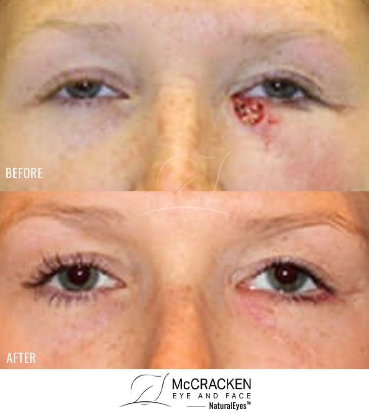 31 Year Old Female – Repair of left lower lid defect after skin cancer excision.