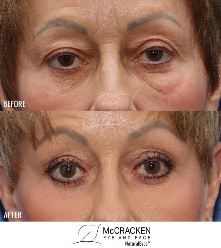 67 Year Old Female Upper and Lower Blepharoplasty Bilateral Upper Lid Ptosis Repair, Excision of Fat Previously Injected to the Lower Lids, and Periocular Laser Skin Resurfacing. A small amount of lower lid skin was excised.