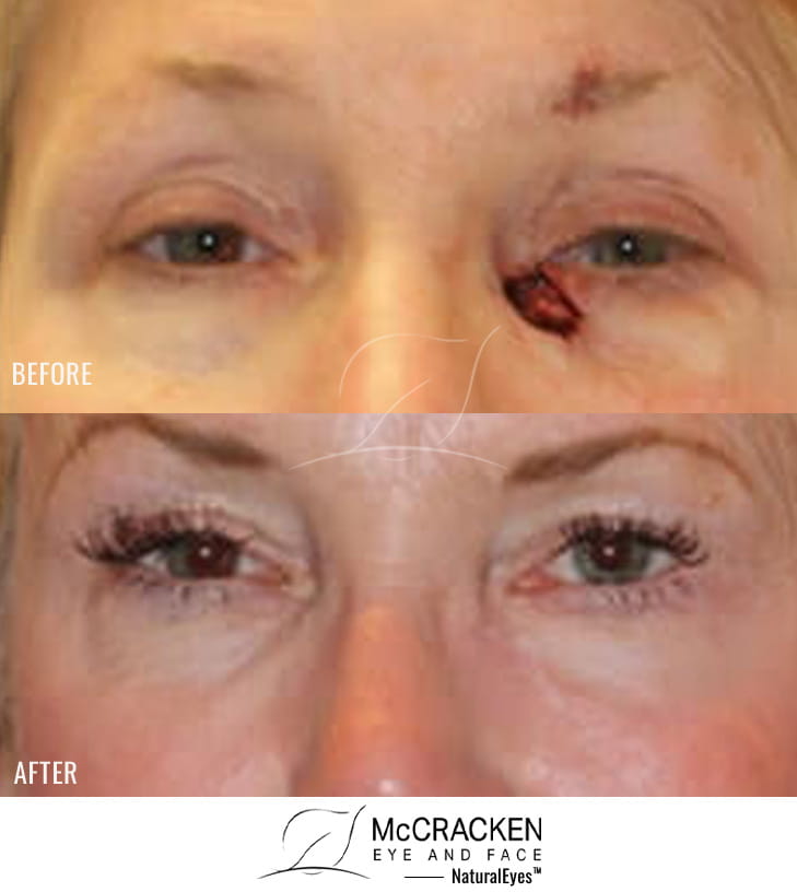 54 Year Old Female – Repair of left lower lid defect after skin cancer excision.