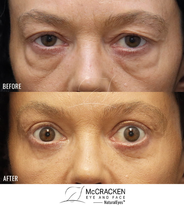 52 Year Old Female Upper and Lower Lid Blepharoplasty with Injection of 5cc of Fat to the Right Cheek and 6cc of Fat to the Left Cheek, and AccuTite to the malar mounds. No Lower Lid Skin Incisions were made.