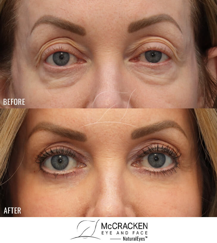 58 Year Old Female Upper and Lower Lid Blepharoplasty with Fat Repositioning, Left Upper Lid Ptosis Repair, Injection of 4cc of Fat to Each Cheek, and Laser Skin Resurfacing. No Lower Lid Skin Incisions were made.