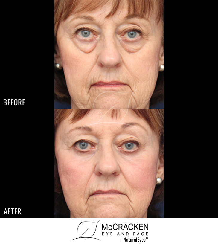 72 Year Old Female – Mid-Facelift with Lower Blepharoplasty and Periocular Laser Skin Resurfacing. The mid-facelift was performed through incisions in the mouth and temples, without any skin incisions. The lower lid blepharoplasty was performed through an incision on the inside of the eyelid with a small strip of skin excision under the lashes.