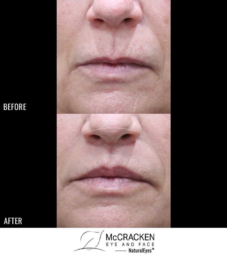 61 Year Old Female – Lip Lift to Enhance the Upper Lip. No Filler Added.