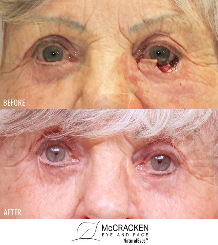 81 year old female – Repair of left lower lid Mohs defect after excision of basal cell carcinoma