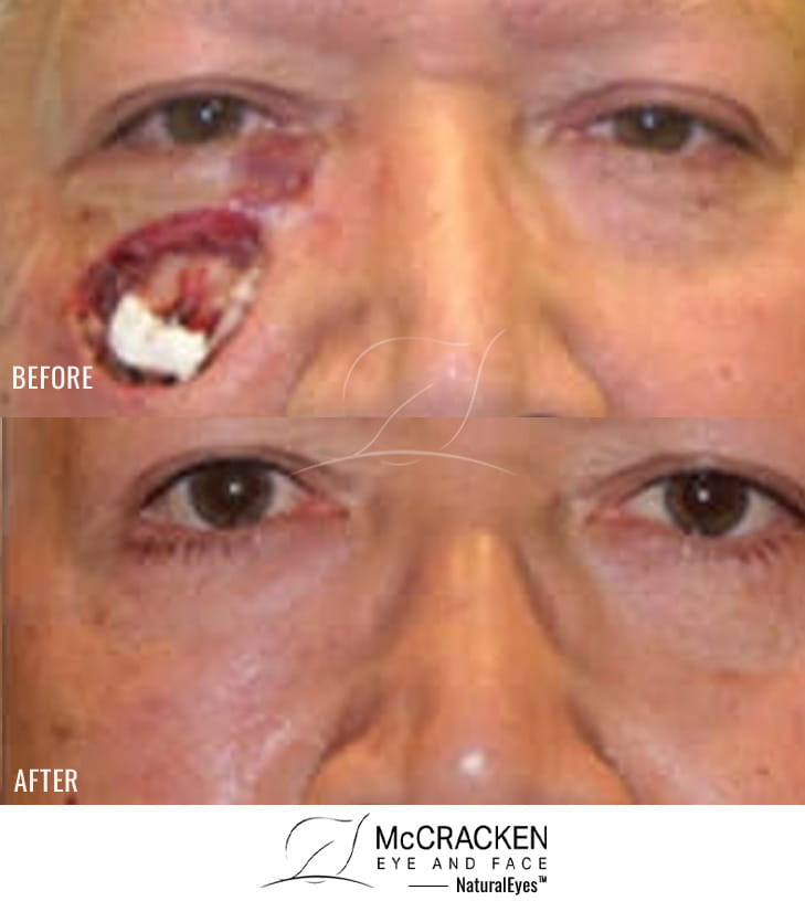 65 Year Old Male – Repair of right lower lid defect after skin cancer excision.