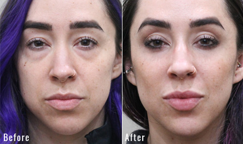 before after lower blepharoplasty patient 1