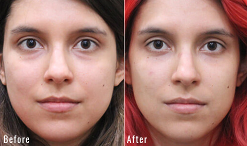 before after lower blepharoplasty patient 2
