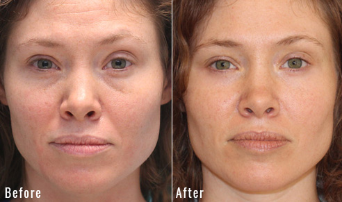 before after lower blepharoplasty patient 3