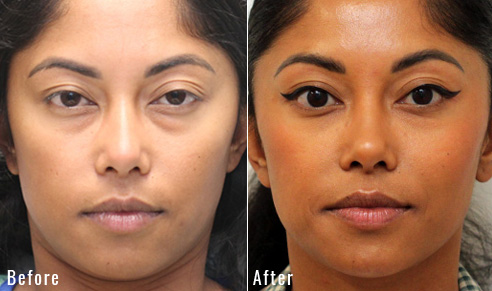 before after lower blepharoplasty patient 4