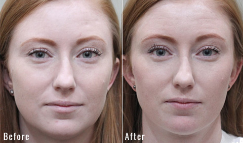 before after lower blepharoplasty patient 5