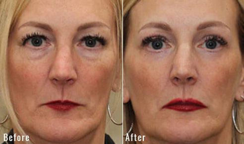 before after upper blepharoplasty patient 1