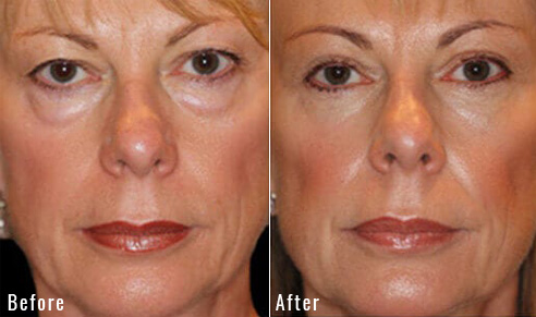 before after upper blepharoplasty patient 2