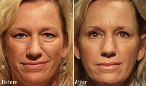 before after upper blepharoplasty patient 3