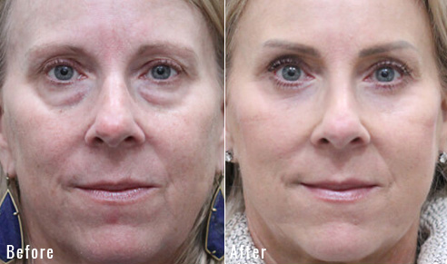 before after upper blepharoplasty patient 4