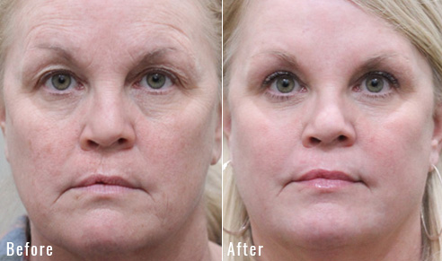 before after upper blepharoplasty patient 5