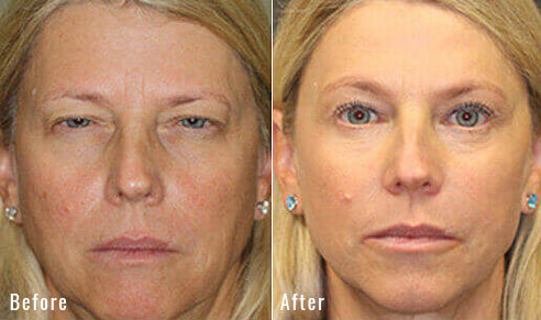 54 Year Old Female – Brow Lift, Upper and Lower Blepharoplasty, and Periocular Laser Skin Resurfacing