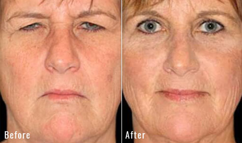 51 Year Old Female – Endoscopic Brow lift and Upper Blepharoplasty