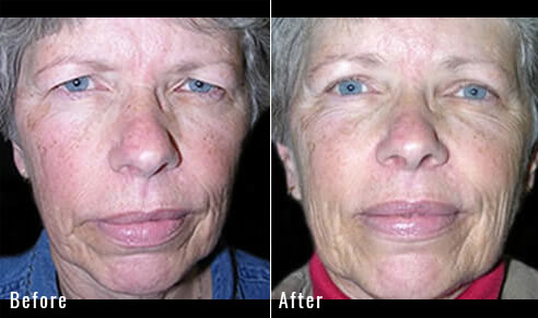 58 Year Old Female – Upper Blepharoplasty and Endoscopic Brow Lift