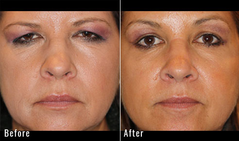 46 year old female – Full face fractional CO2 laser skin resurfacing, Endoscopic brow lift