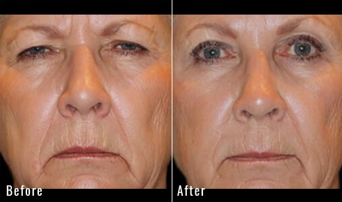 67 year old female – Full face fractional CO2 laser skin resurfacing, Bilateral endoscopic brow lift Bilateral upper and lower lid blepharoplasty