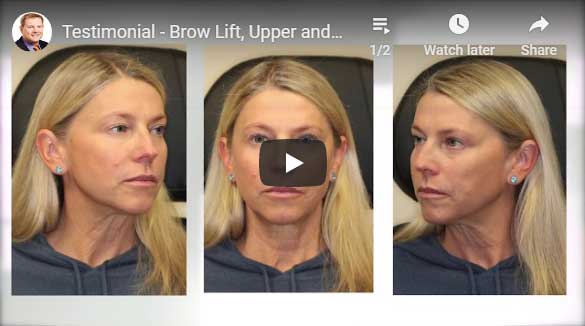 Testimonial – Brow Lift, Upper and Lower Blepharoplasty, and CO2 Laser Skin Resurfacing