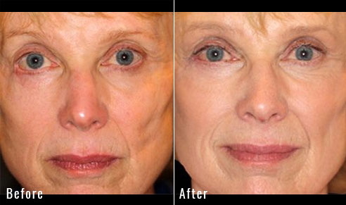 67 Year Old Female – Repair of Lower Lid Retraction