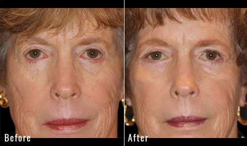 64 Year Old Female – Repair of Lower Lid Retraction After Unsatisfactory Blepharoplasty