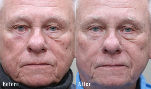 78 Year Old Male – Repair of Right Lower Lid Retraction After Unsatisfactory Skin Cancer Repair elsewhere