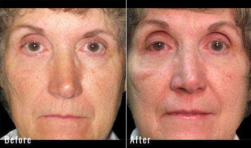 64 Year Old Female – Repair of Lower Lid Retraction After Unsatisfactory Blepharoplasty