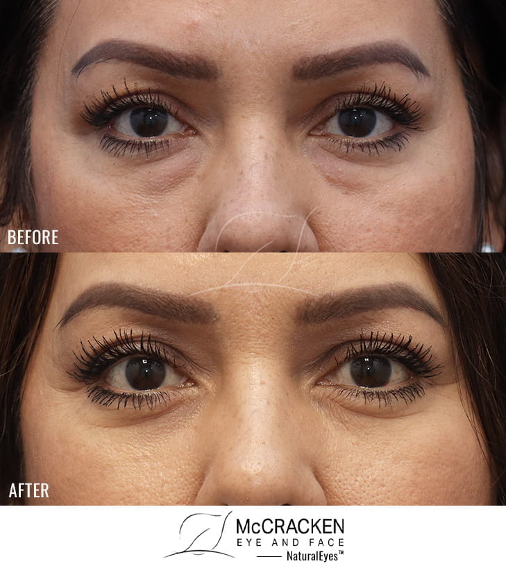 43 Year Old Female Lower Lid Blepharoplasty with Fat Repositioning and Injection of 3cc of Fat to Each Cheek. No Lower Lid Skin Incisions were made.