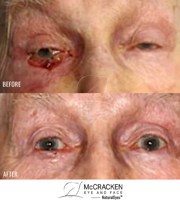 95 Year Old Female – Repair of right lower lid defect after skin cancer excision.