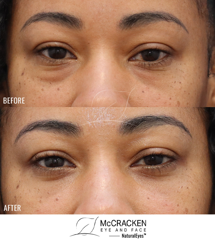 44 Year Old Female – Lower Lid Blepharoplasty with Fat Repositioning, Injection of 3 cc of Fat to Each Cheek, and Injection of 1 cc of NanoFat Per Lower Lid. No Lower Lid Skin Incisions were made.