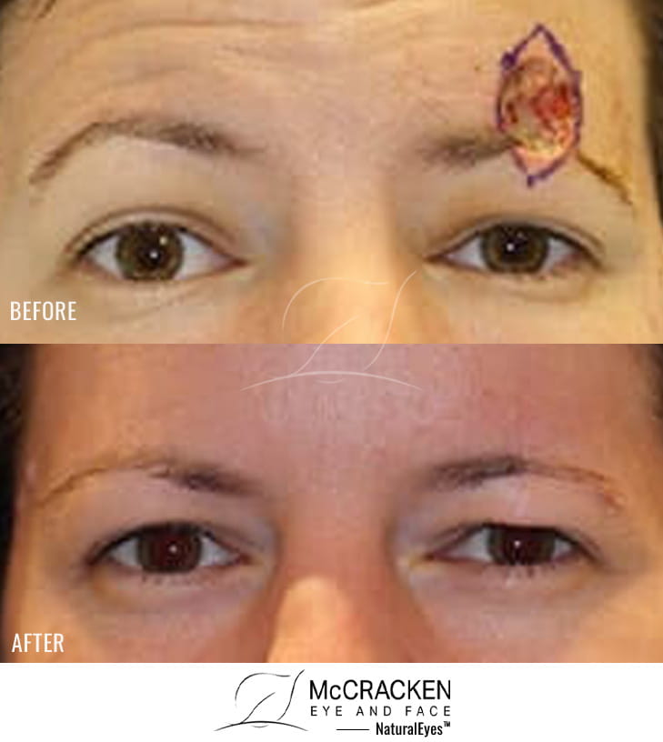 38 year old female – Repair of left brow defect after skin cancer excision