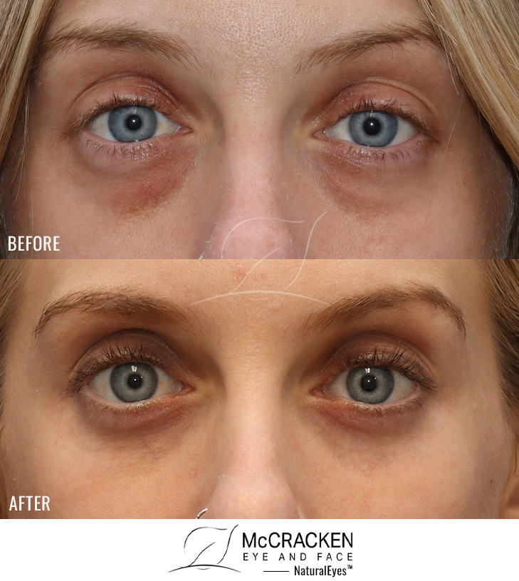 36 Year Old Female – Lower Lid Blepharoplasty with Fat Repositioning, Injection of 4cc of Fat to Each Cheek and Laser Skin Resurfacing. No Lower Lid Skin Incisions were made.