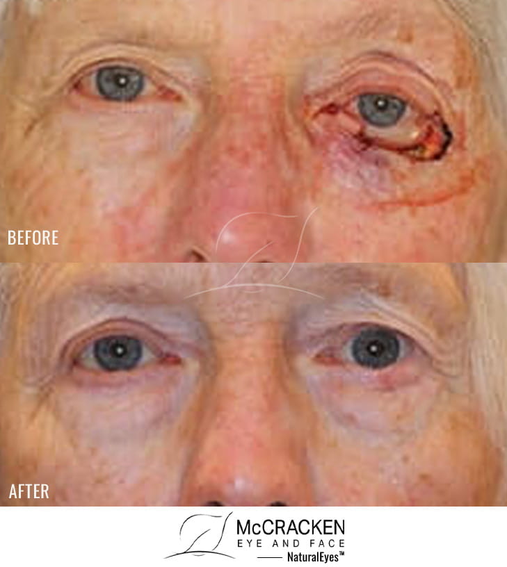 75 year old female – Repair of left lower lid defect after skin cancer excision