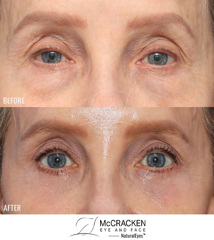 59 Year Old Female – Bilateral Upper Lid Ptosis Repair, Bilateral Lower Lid Blepharoplasty Injection of 5cc of Fat to Each Cheek, and Laser Skin Resurfacing. No Lower Lid Skin Incisions were made.