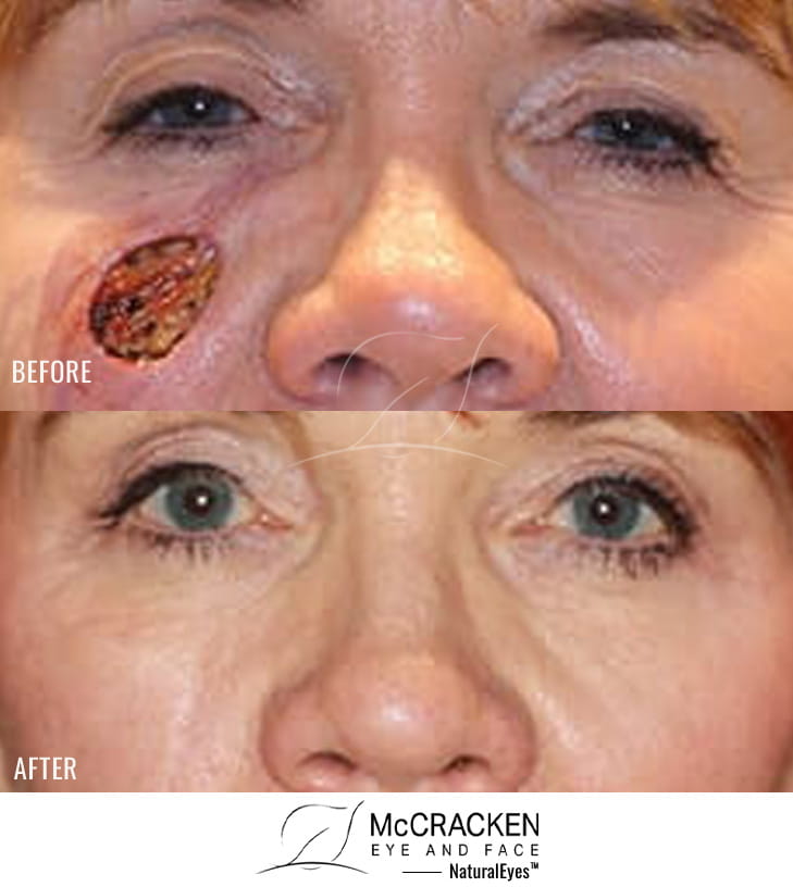 63 year old female – Repair of right cheek defect after skin cancer excision