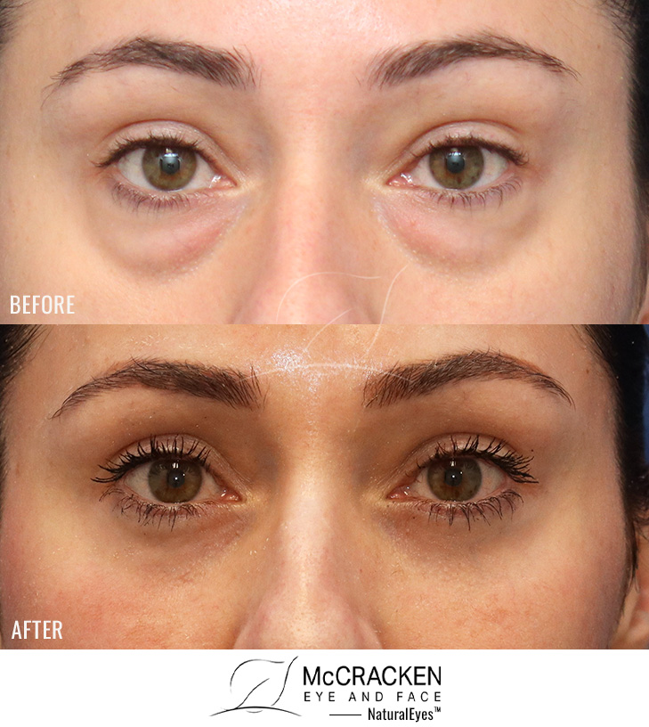 36 Year Old Female – Lower Lid Blepharoplasty with Fat Repositining, Injection of 4cc of Fat to Each Cheek and Laser Skin Resurfacing. No Lower Lid Skin Incisions were made.