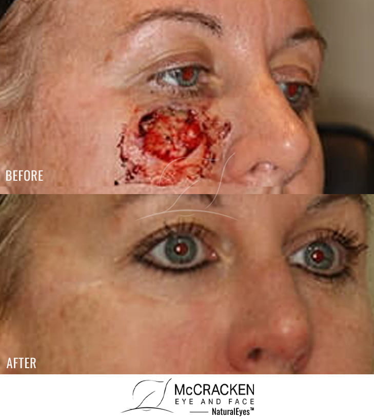 44 year old female – Repair of right cheek defect after skin cancer excision
