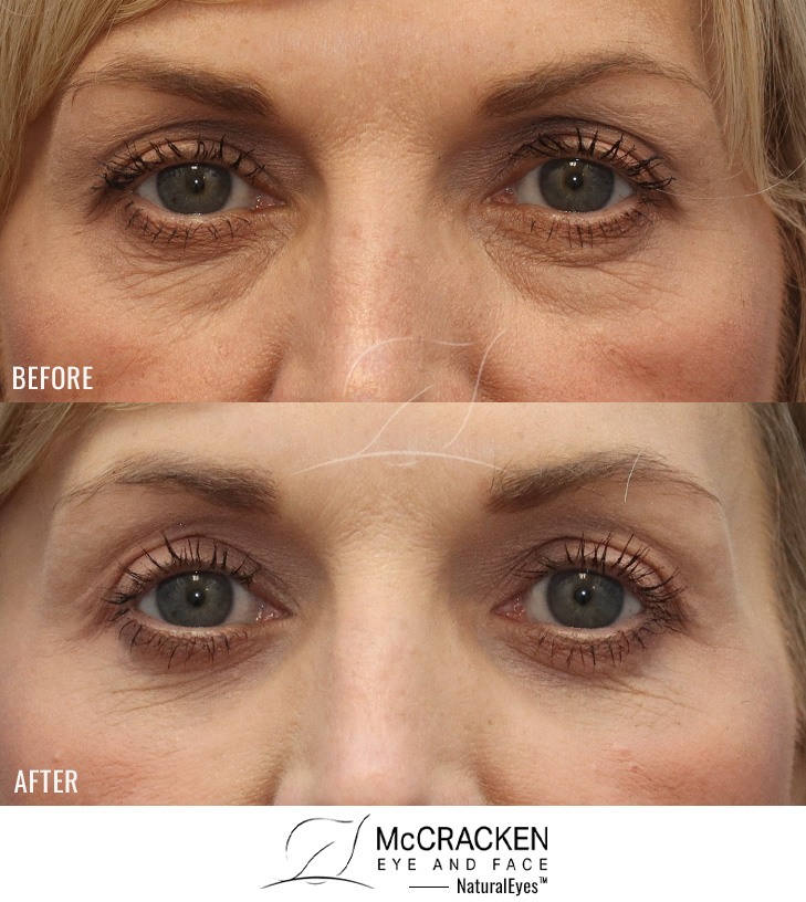 54 Year Old Female – Upper and Lower Lid Blepharoplasty with Injection of 4cc of Fat to Each Cheek and Laser Skin Resurfacing. No Lower Lid Skin Incisions were made.