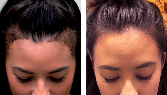  Before and After Picture  
26 Year Old Female, 1 day s/p and 6 Months s/p 650 Grafts to the Hairline