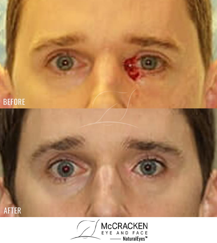 36 year old male – Repair of left medial canthal defect after skin cancer excision