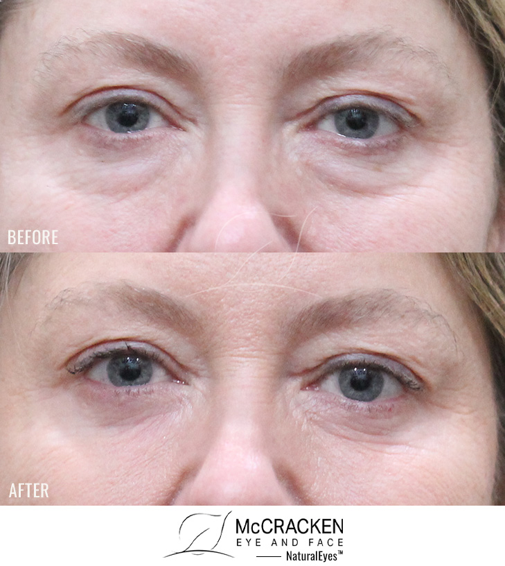 54 Year Old Female – Lower Blepharoplasty with Periocular Laser Skin Resurfacing. No lower lid skin incisions were made.
