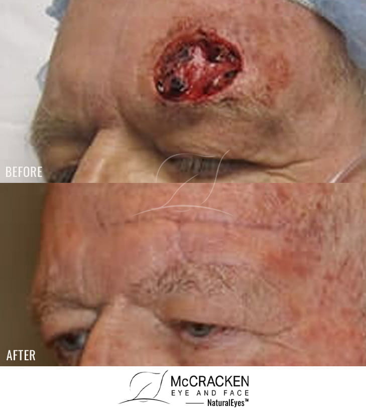 70 year old male – Repair of left brow defect after skin cancer excision